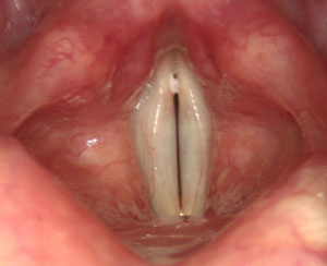 Larynx closed