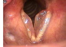 Reinke's oedema