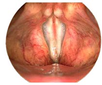 The larynx - closed